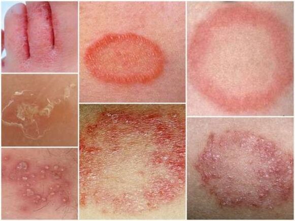 Трихофитоза на кожата на краката